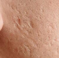 acne scars