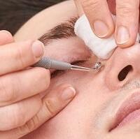 blackheads